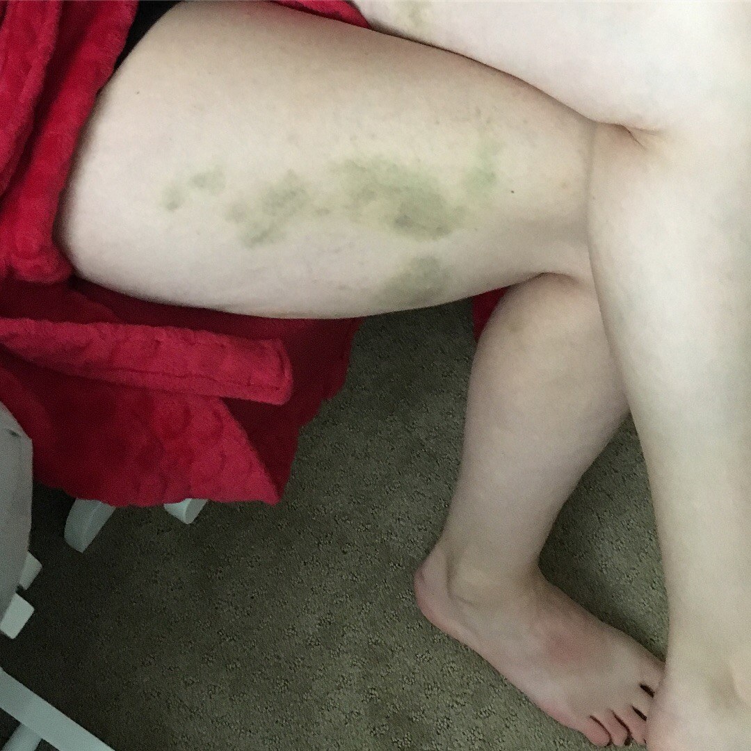 Physical symptoms during toxic mold illness
